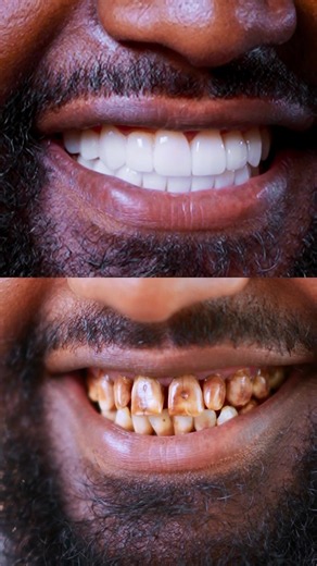 From damaged teeth to a beautiful, confident smile.🦷 #venners #smilemakeover #dentaltransformation #cosmeticdentistry #smiledesign
