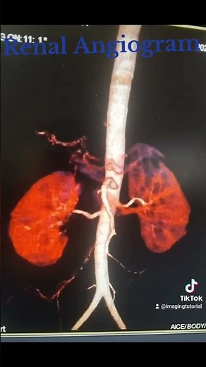 CT Scan Renal Angiogram. 3D Reconstruction Volume Rendering and Maximum Intensity Projection (MIP)