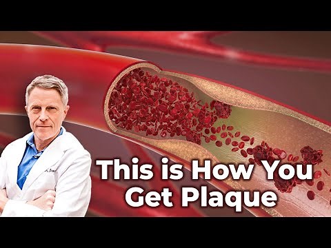 Arterial Plaque Build Up What It Looks Like Inside?