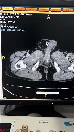 Understanding Inguinal Hernia: Symptoms and Solutions | #ctscan