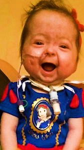 Isla has the only known case of 'Benjamin Button' disease in the world ❤️ #fbreels #borndifferent #benjaminbutton #rarecondition #agingdisease | Born Different