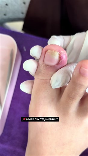 #ตัดเล็บขบสุราษฎร์ธานี #ตัดเล็บขบ #เล็บขบ #ตัดเล็บขบมือ #หนังขบ