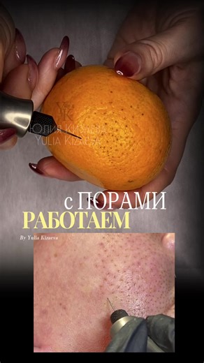 Fibroblast • Plasma Pen on TikTok