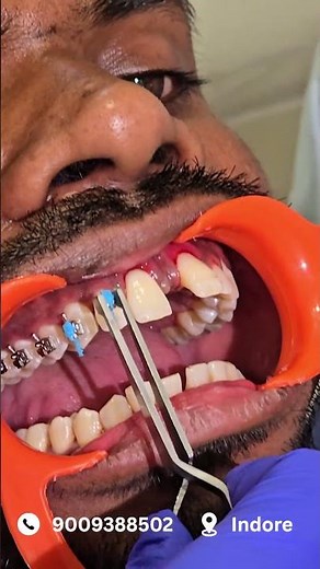 Braces Placement Procedure 😱 Watch Teeth Transformation Begin | Indore