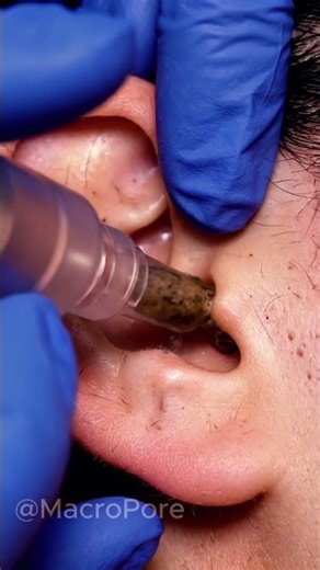 Macro Ear Pore Vacuum Removal | Clear Tube 4K