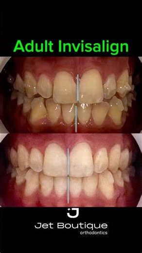 Adult Invisalign: Real Before and “After” Photos (*treatment in progress)…