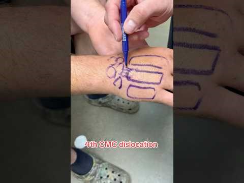 Dislocation of the…hand?#familymedicine #sportsmedicine #sportsmed #medstudent #physician