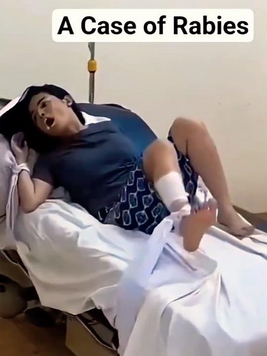 Hydrophobia in Humans | Real Rabies Patient Reaction