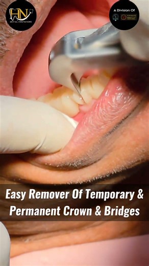 Hn Prolift Crown Remover Forceps #dentalinnovation #dentist #crownremoverforceps #shorts #viral #yt