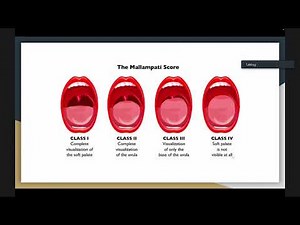 Rapid Sequence Intubation