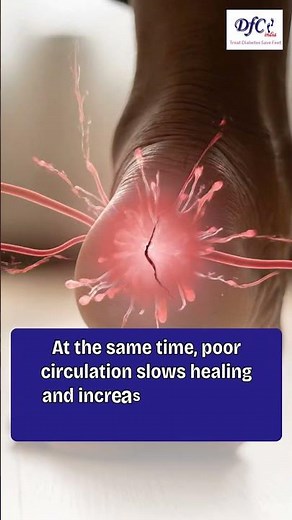Why A Diabetic Foot Ulcer Is More Serious Than Most People Think | DFC Clinic