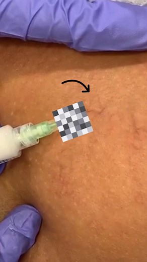 30 million Americans experience symptoms of vein disease: ❌ Leg Pain ❌ Aching ❌ Swelling ❌ Cramping ❌ Itching Experience the joy of healthy legs with state-of-the-art vein care! | Metro Vein Centers