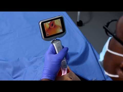 Insighters® iS6 Handheld Video Laryngoscope System - Instructional Video
