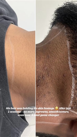Laser Hair Removal Transformation: Before & After Results