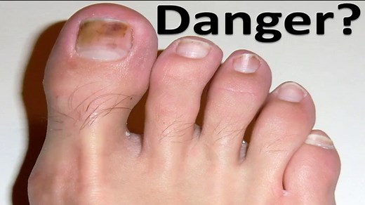 Red Toenail Bed [Causes, Home Remedies & Best Treatment!]