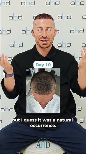 Arthur’s 3300 Graft Hair Transplant Result | AHD Clinic & Dr. Hakan Doganay