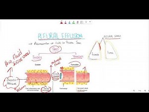 Pleural effusion;Transudate vs exudate /Light criteria
