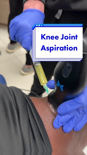 Knee Joint Aspiration: Relieving Excess Synovial Fluid