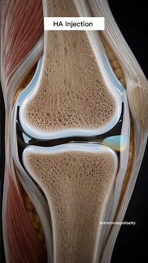 HA Injection for Knee Pain | | How Hyaluronic Acid Injection works | Dr. Srinivas Polisetty #ortho