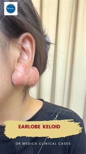Earlobe keloid || Dr Medica Clinical Cases || Education || Diagnosis ||