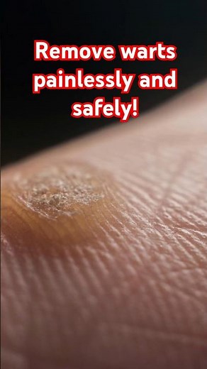 Fastest way to remove warts | Painlessly and Safely ✨