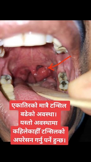 Dr Krishna Koirala ENT Pokhara on TikTok