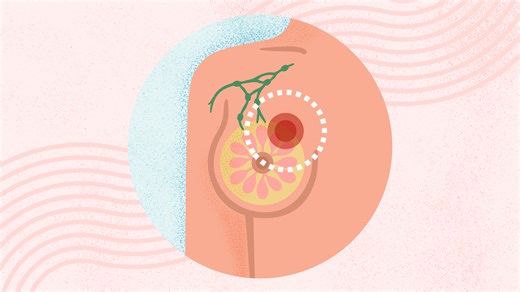 What Is Breast Cancer? Symptoms, Causes, Diagnosis, Treatment, and Prevention