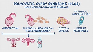 Video: Polycystic ovary syndrome (PCOS): Clinical sciences - Video Explanation! | Osmosis | Osmosis