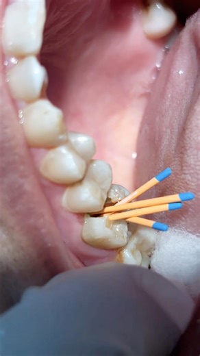 Root canal treatment step 2#rootcanal #rootcanaltreatment #dentist #shorts #trend #dentalclinic