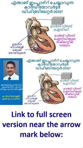 What is an implantable cardioverter defibrillator?