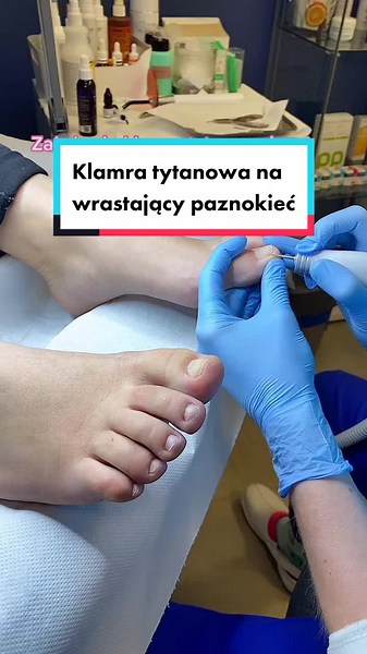 Jak leczyć wrastające paznokcie - poradnik