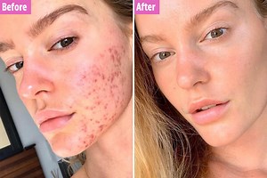 Model who battled chronic acne reveals skin transformation after changing diet