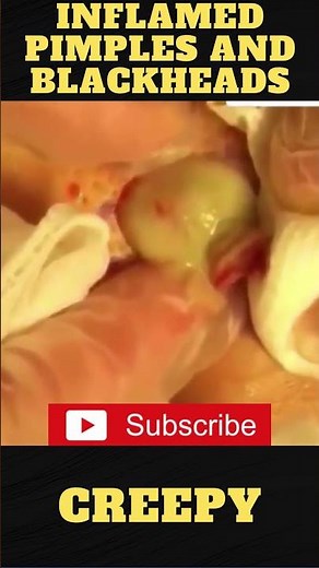 Removal Explosion Pimples Popping Acne pus and inflamed blackheads 21#