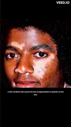 The Truth About Michael Jackson's Skin: Understanding Vitiligo