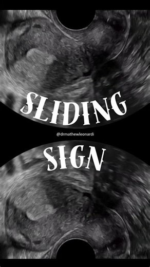 SLIDING SIGN TO ASSESS FOR ENDOMETRIOSIS #ultrasound #gynecologist #endometriosis