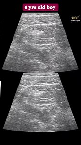 Diagnose 😯😦 #Radiology #Ultrasound #MedicalImaging #FetalUltrasound #ObstetricUltrasound #PrenatalUltrasound #Sonography #DiagnosticImaging #FetalAnomalyScan #PrenatalScreening #ObstetricRadiology #FetalMedicine #MaternalFetalHealth #EarlyPregnancyScan #Radiologist #Sonographer #MedicalDiagnosis #OBGYN #PerinatalCare #HighRiskPregnancy #MaternalHealth #Medical #Healthcare #MedLife #FutureDoctor #MedTech #MedicalScience #DoctorLife #HealthTips | Ultrasound report expert