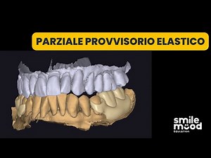 Exocad Tutorials | Temporary elastic partial