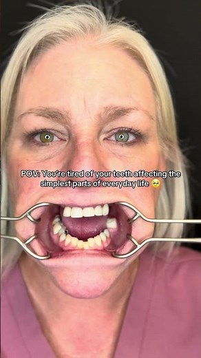 Her All-on-6 Dental Implants Gave Her More Than a New Smile 🥹 #dentalimplants
