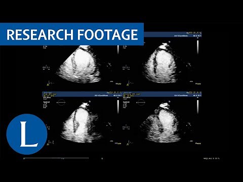 Dobutamine stress echocardiography to diagnose coronary artery disease