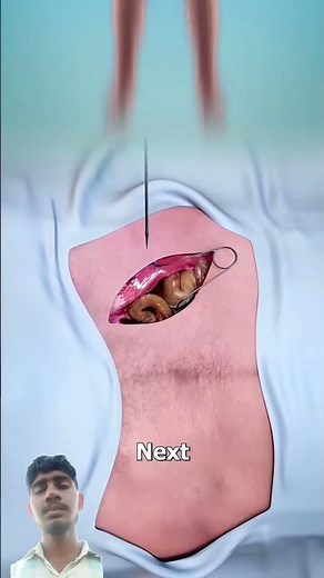 How Embalming A Body Works