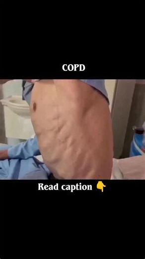 Pure medicine on Instagram: "Living with COPD (Chronic Obstructive Pulmonary Disease) is more than just “being short of breath.” It’s waking up every day having to think about your breathing before anything else. It’s learning to pace yourself, to rest without guilt, and to celebrate the smallest victories that others may never notice. Some days are heavy, some days are hopeful, but every day takes strength. COPD teaches patience, resilience, and deep appreciation for simple moments—like a calm