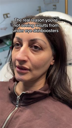 Effective Skin Boosters for Delicate Under-Eye Skin