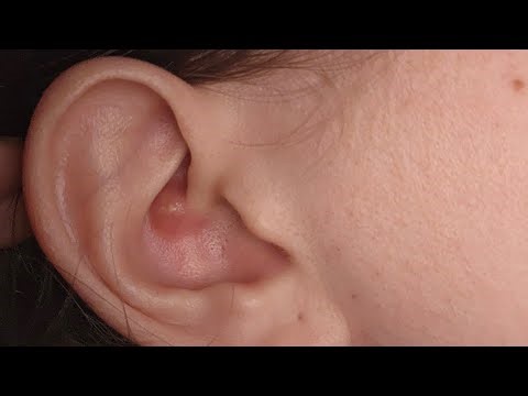 Popping a huge pimple in my ear