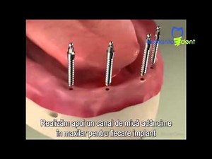 Implants Mini Implant Overdenture Procedure