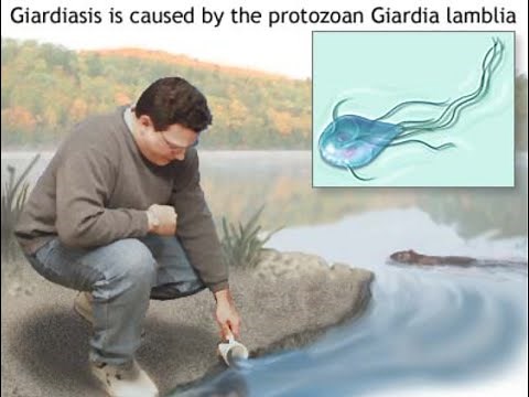 Giardiasis