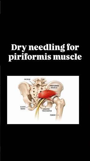 Dry needling for piriformis muscle