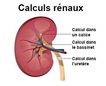 Lithiase rénale : symptômes, traitement, définition