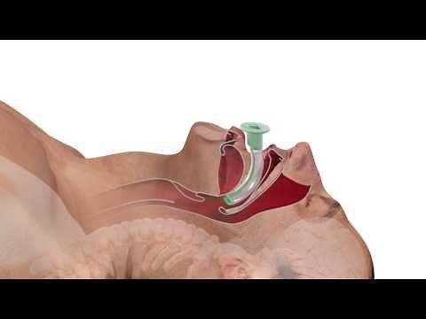 Einteilige PVC-freie Guedel-Tuben
