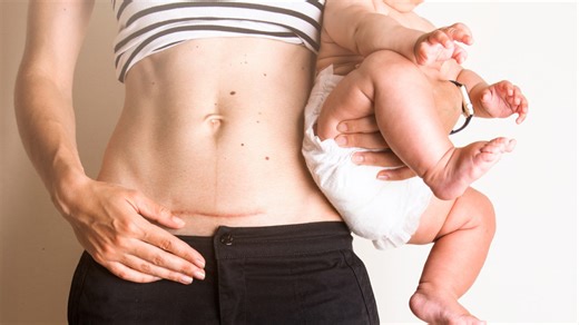 Expert Shares Long-Term Health Implications Of Being Born Through A C-Section