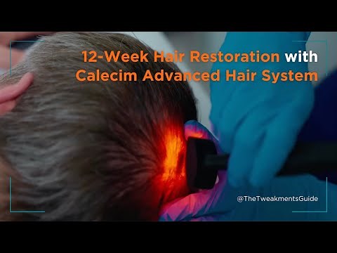 12-Week Hair Restoration with Calecim Advanced Hair System